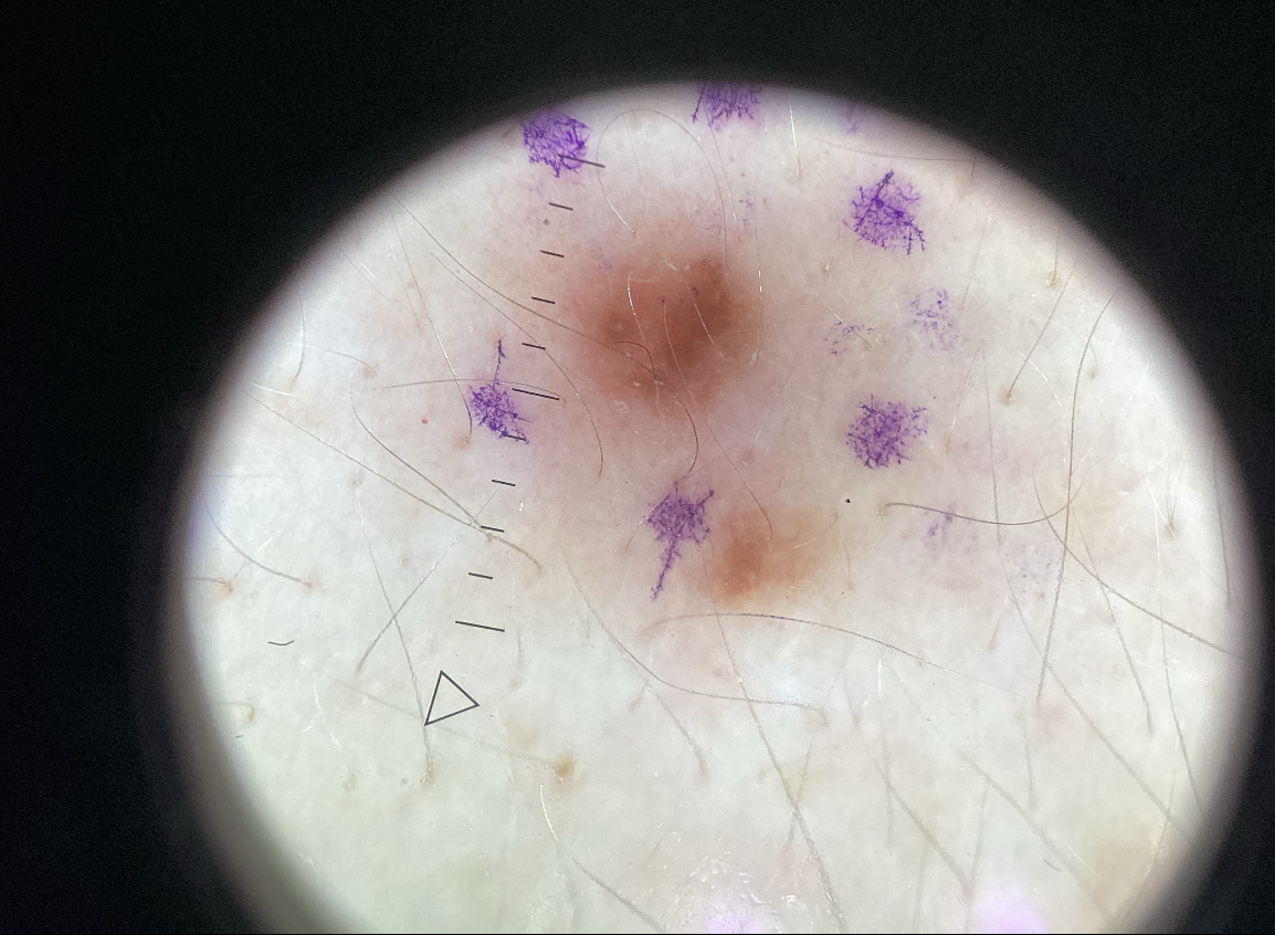 Benign Nevus Type 2