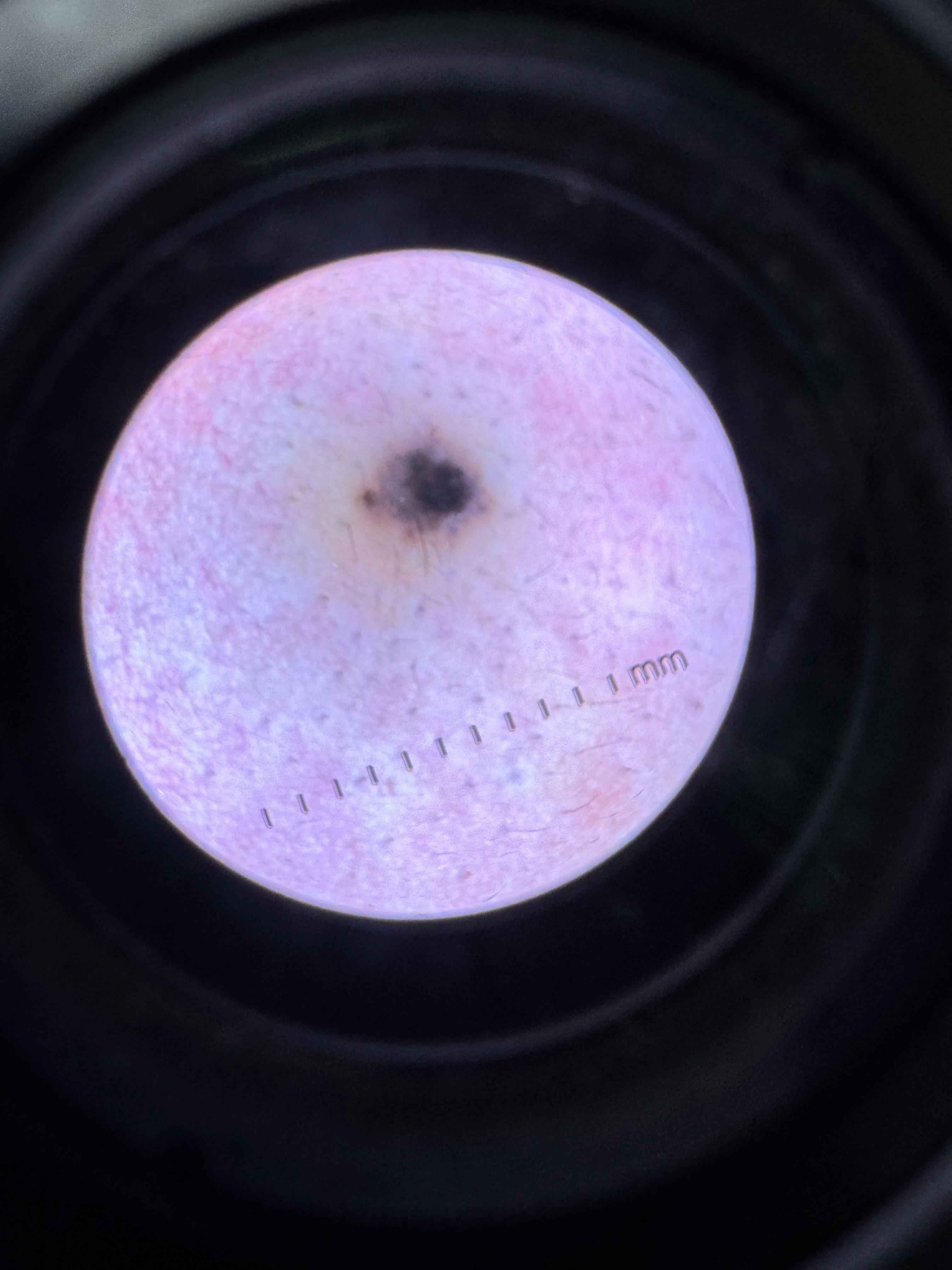Benign Nevus Type 4a