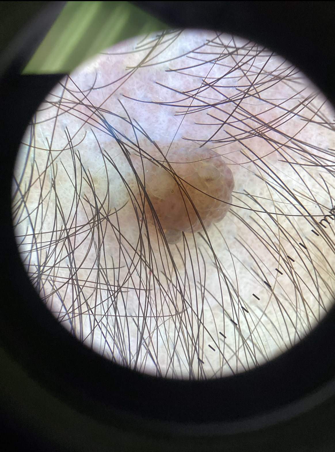 Benign Nevus Type 4b
