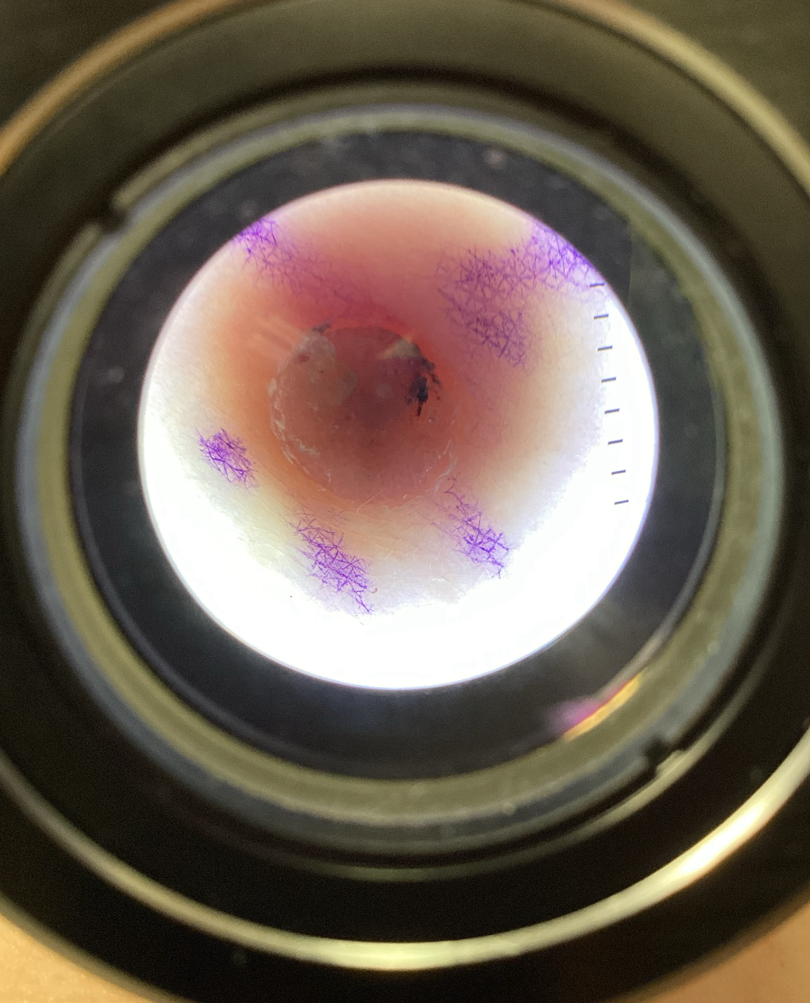 Benign Nevus Type 1