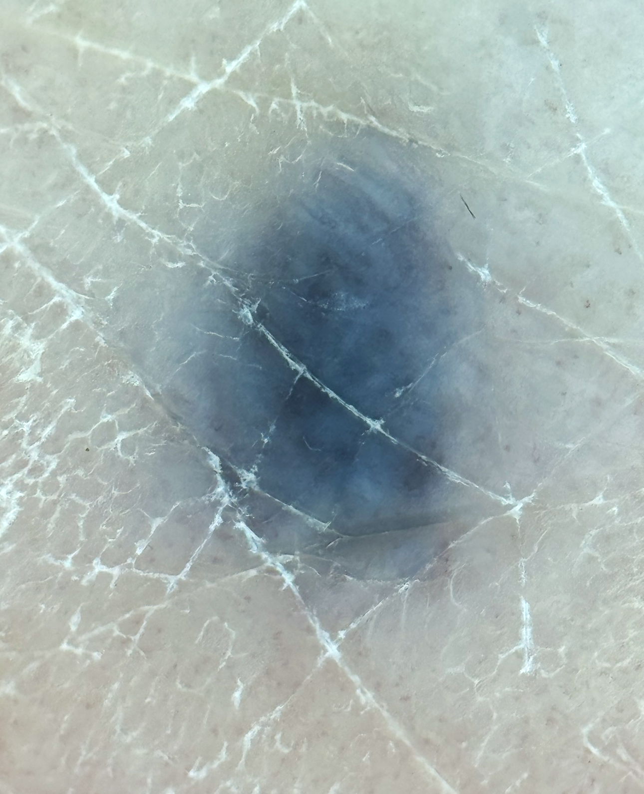 Blue Nevus Dermoscopy