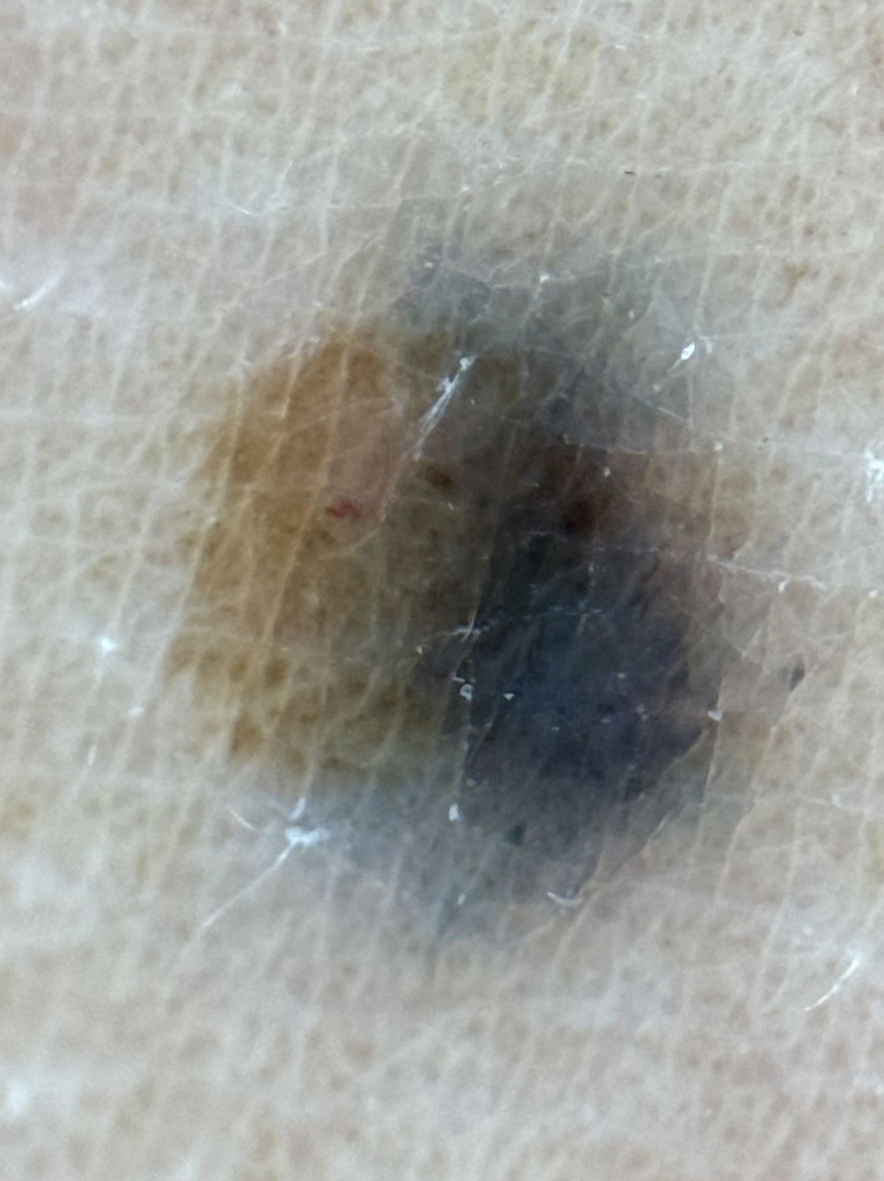 developing blue nevus over compound nevus