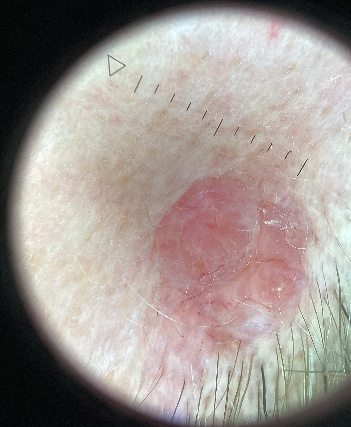 Cutaneous B Cell Lymphoma