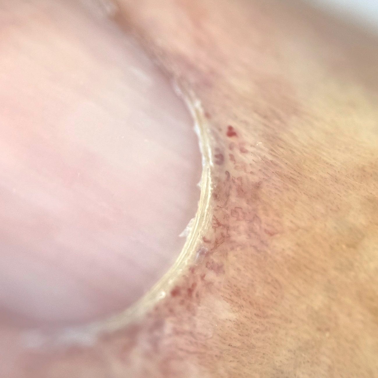 Dilated Nail Fold Capillary in SLE Dermoscopy