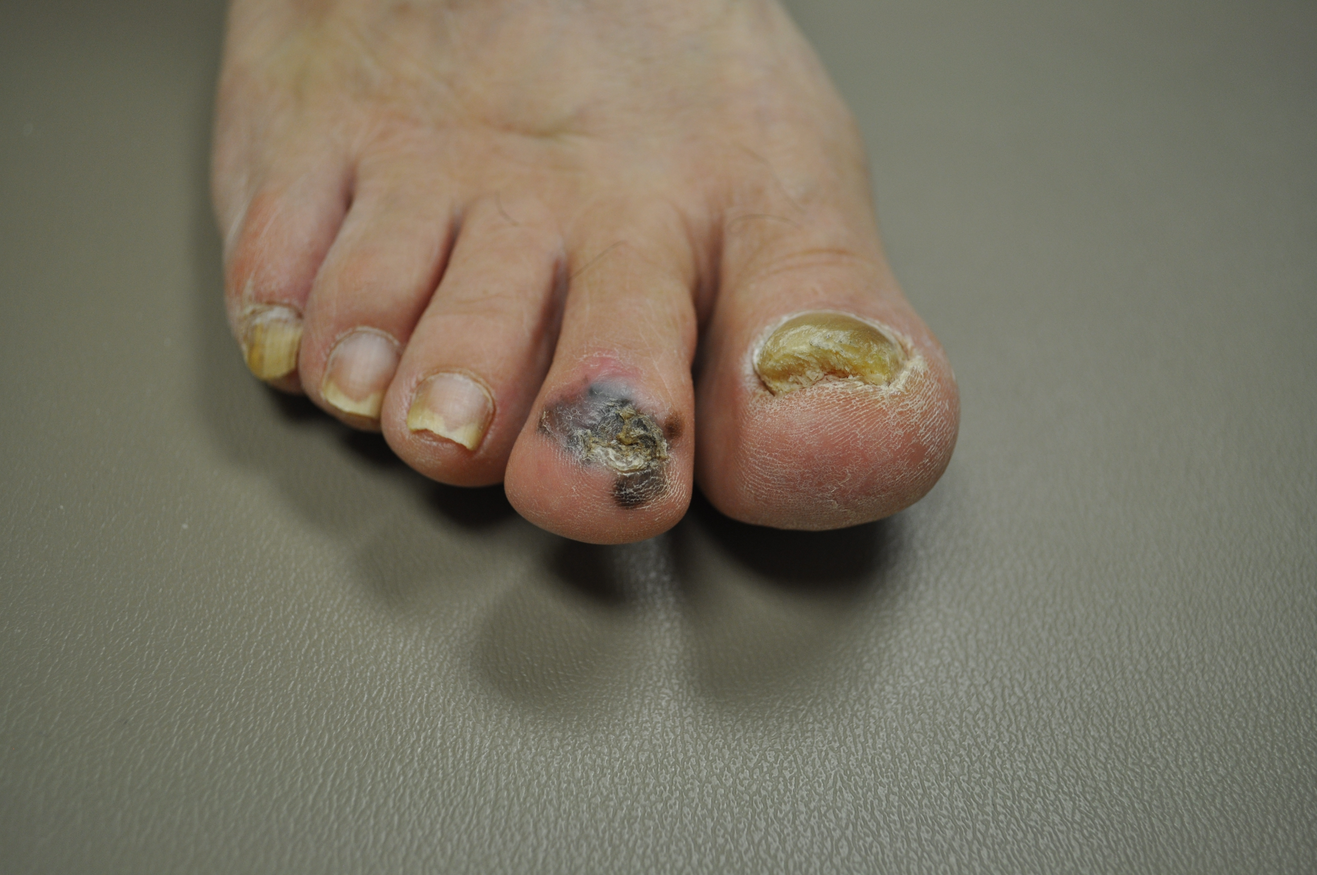 melanoma type 4 foot