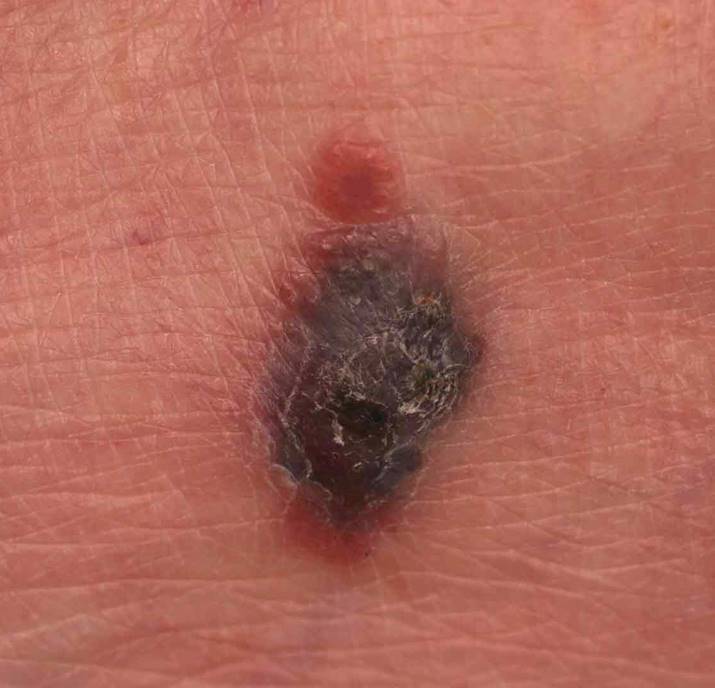 melanoma type 4b