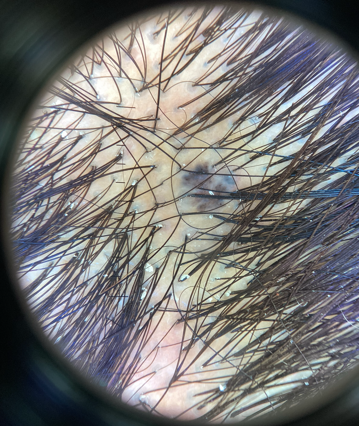 pigmented bcc type 4