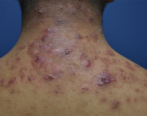 Skin Lesions: Types, Pictures, Diagnosis, Treatment & More