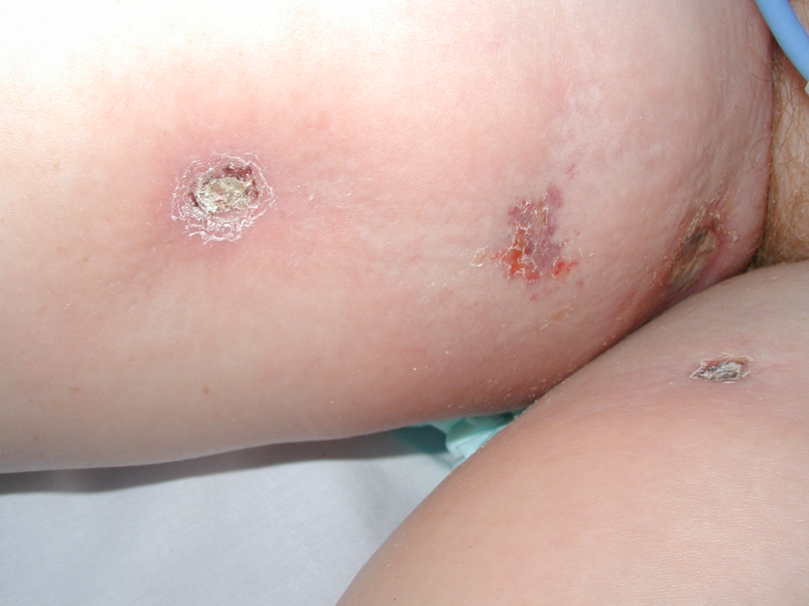 Calciphylaxis Type 1a
