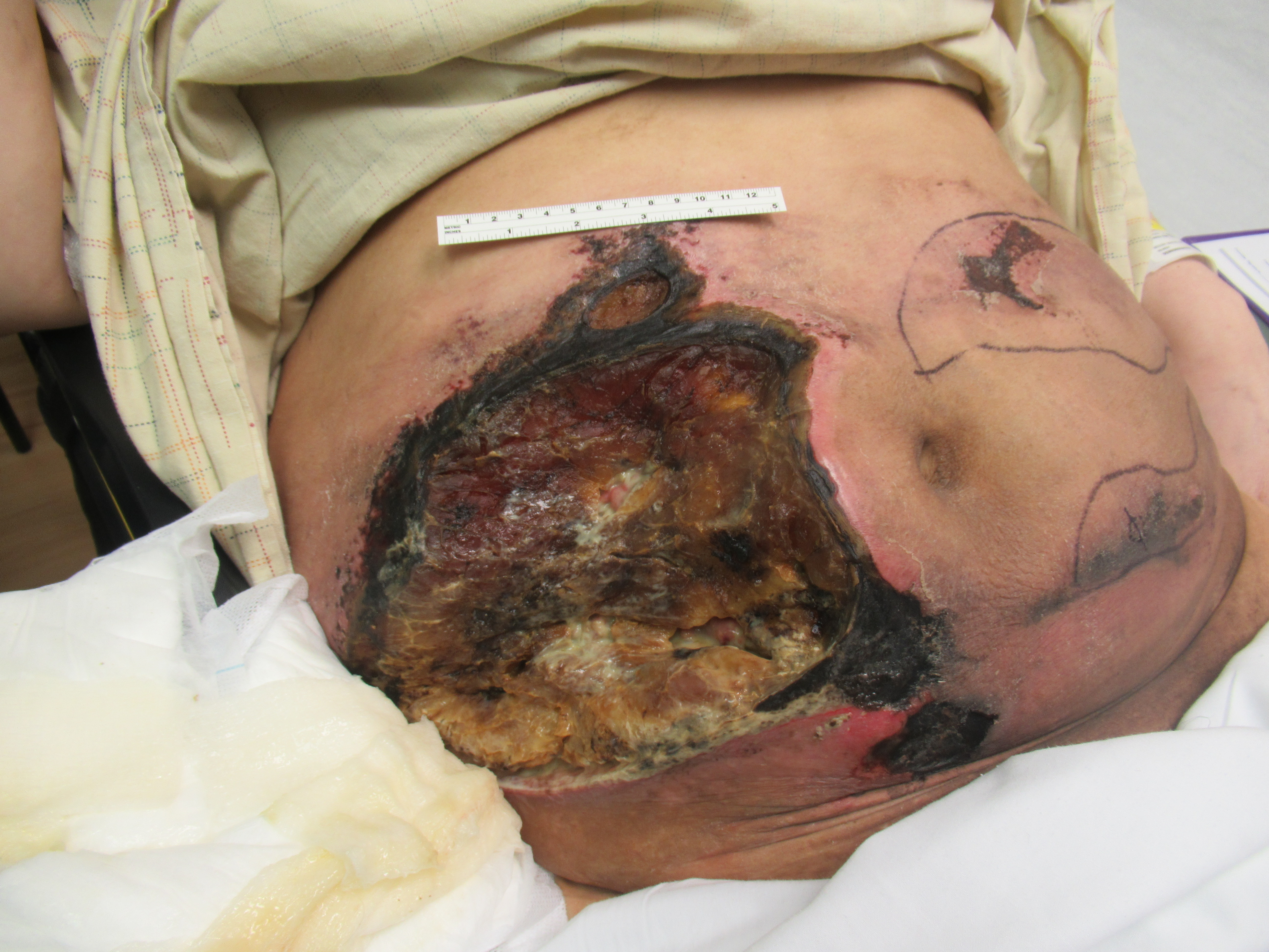 Calciphylaxis Type 2a