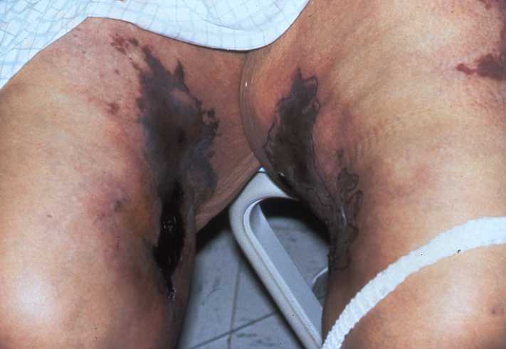 Calciphylaxis Type 2b