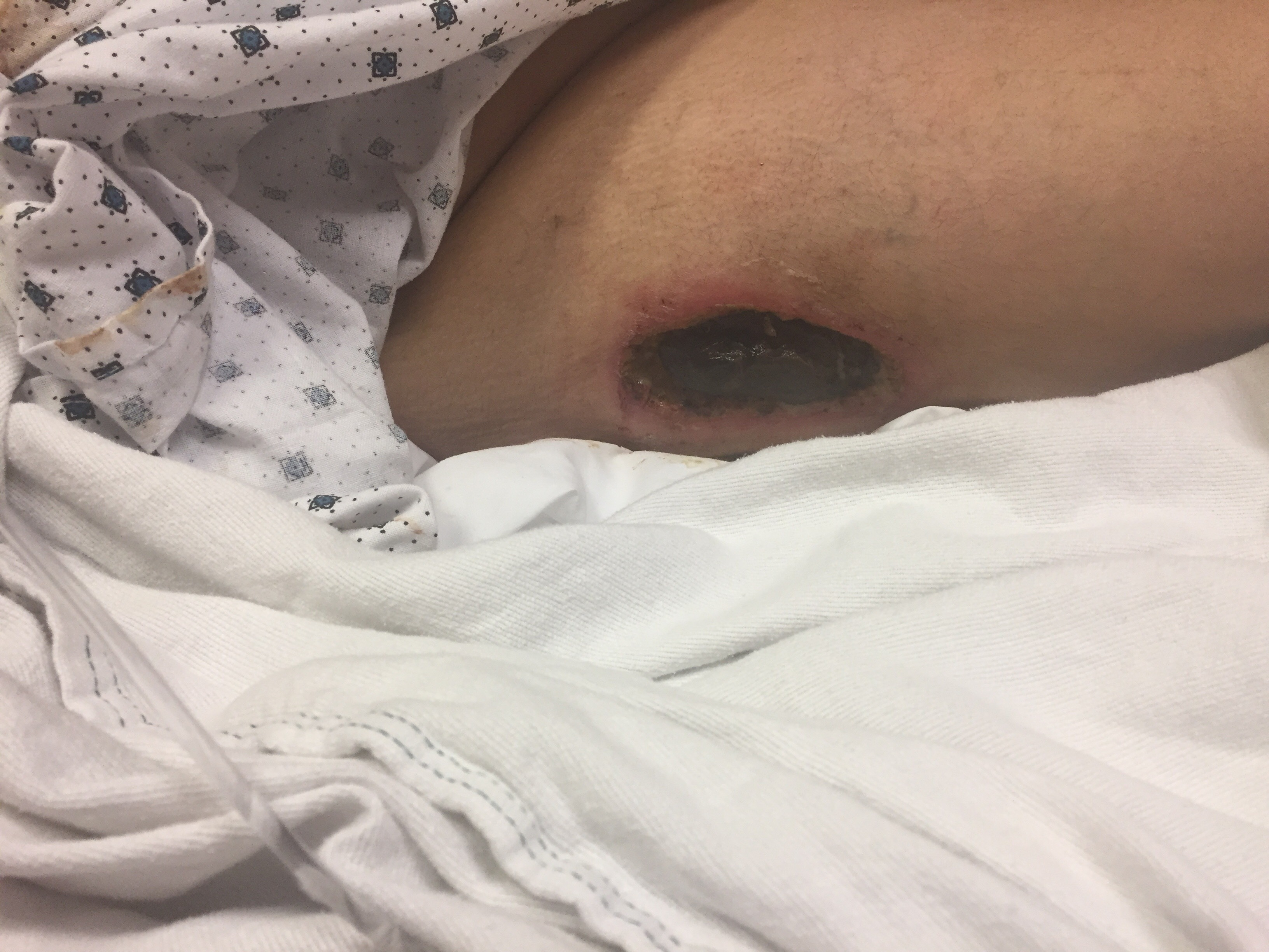 Calciphylaxis Type 3a