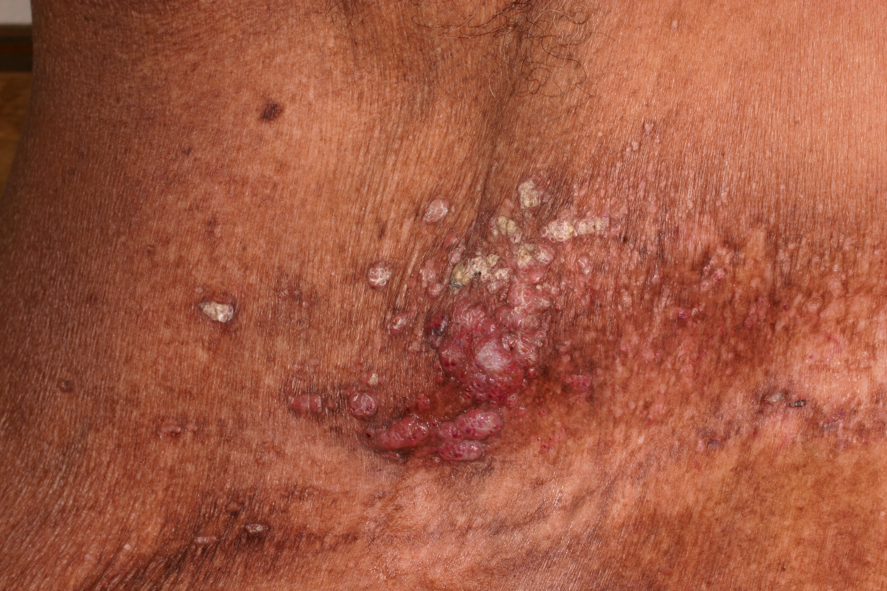 Calciphylaxis Type 3b