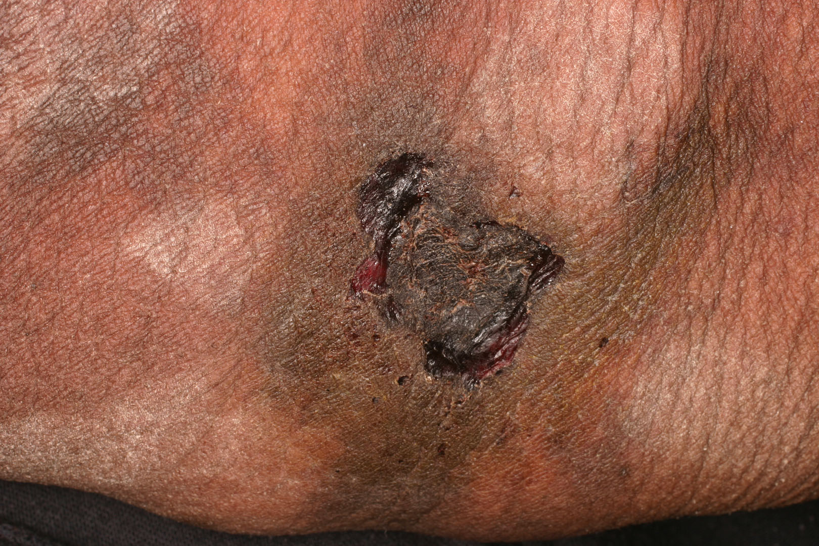 Calciphylaxis Type 4a
