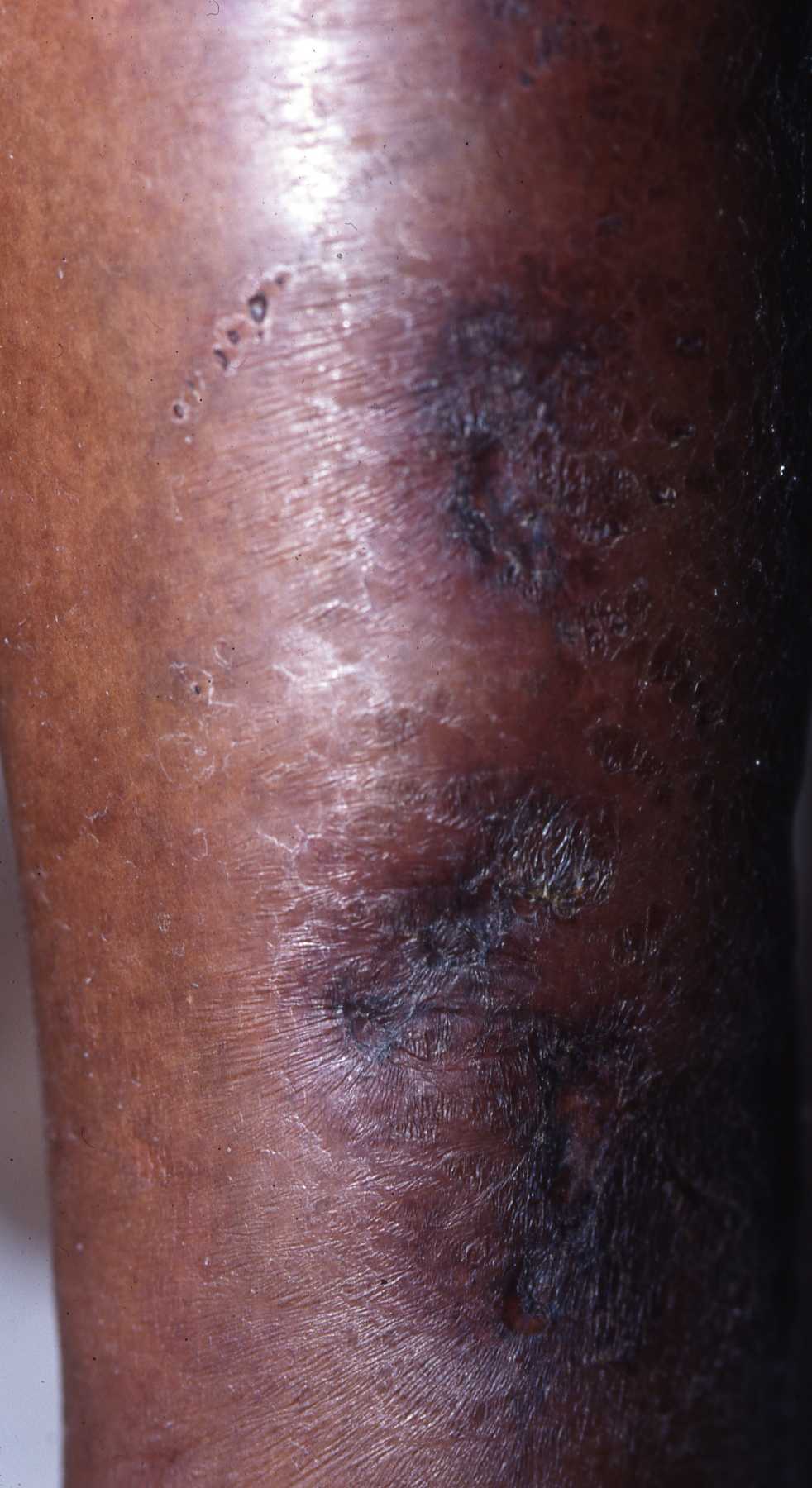 Calciphylaxis Type 5a