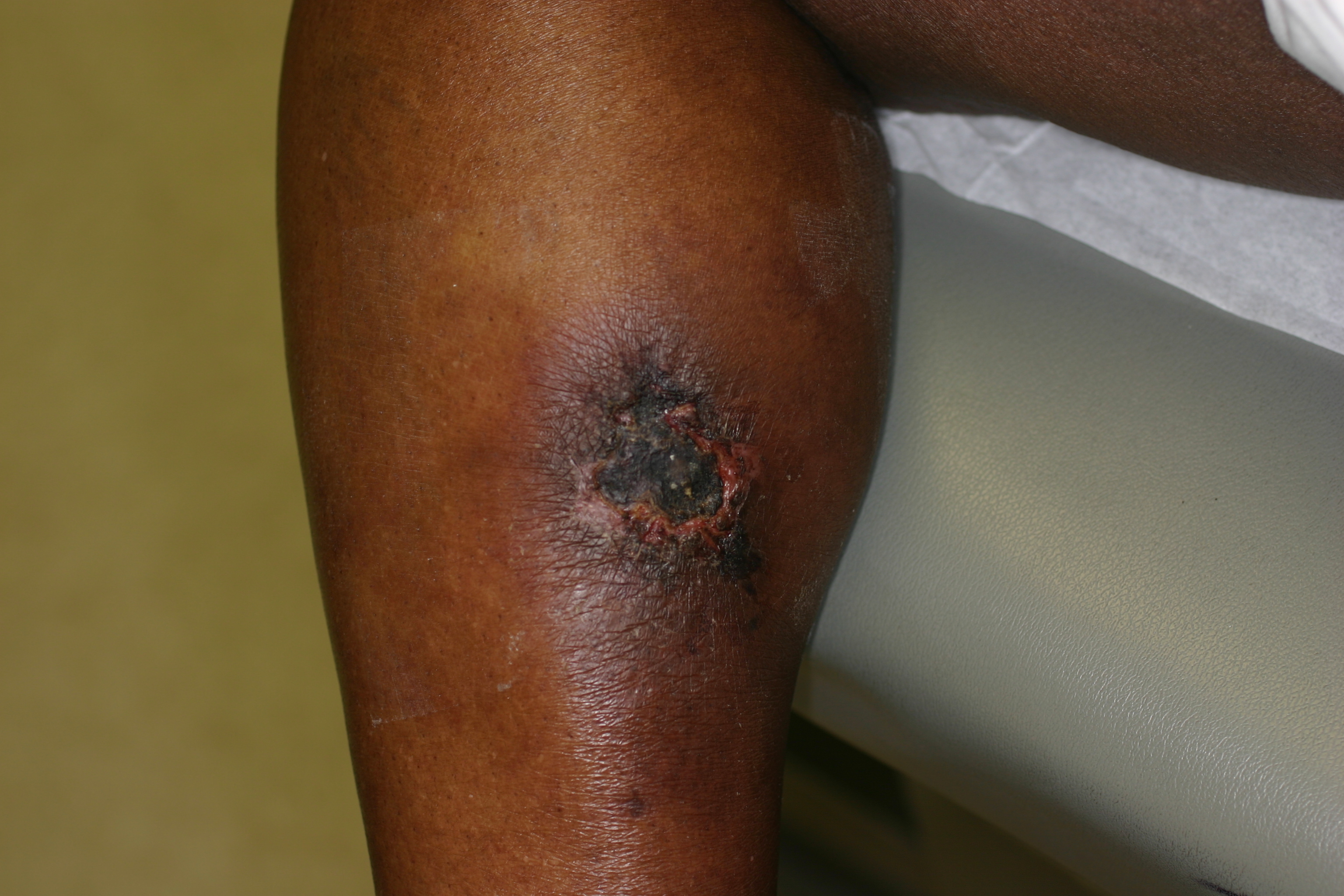Calciphylaxis Type 5b