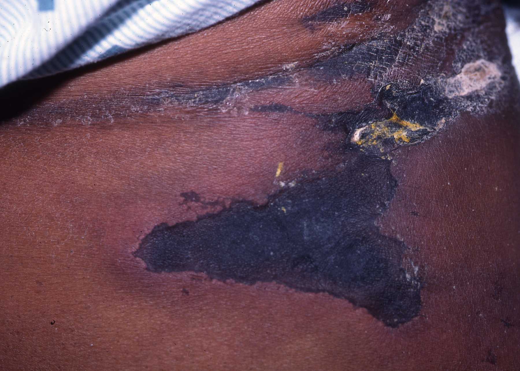 Calciphylaxis