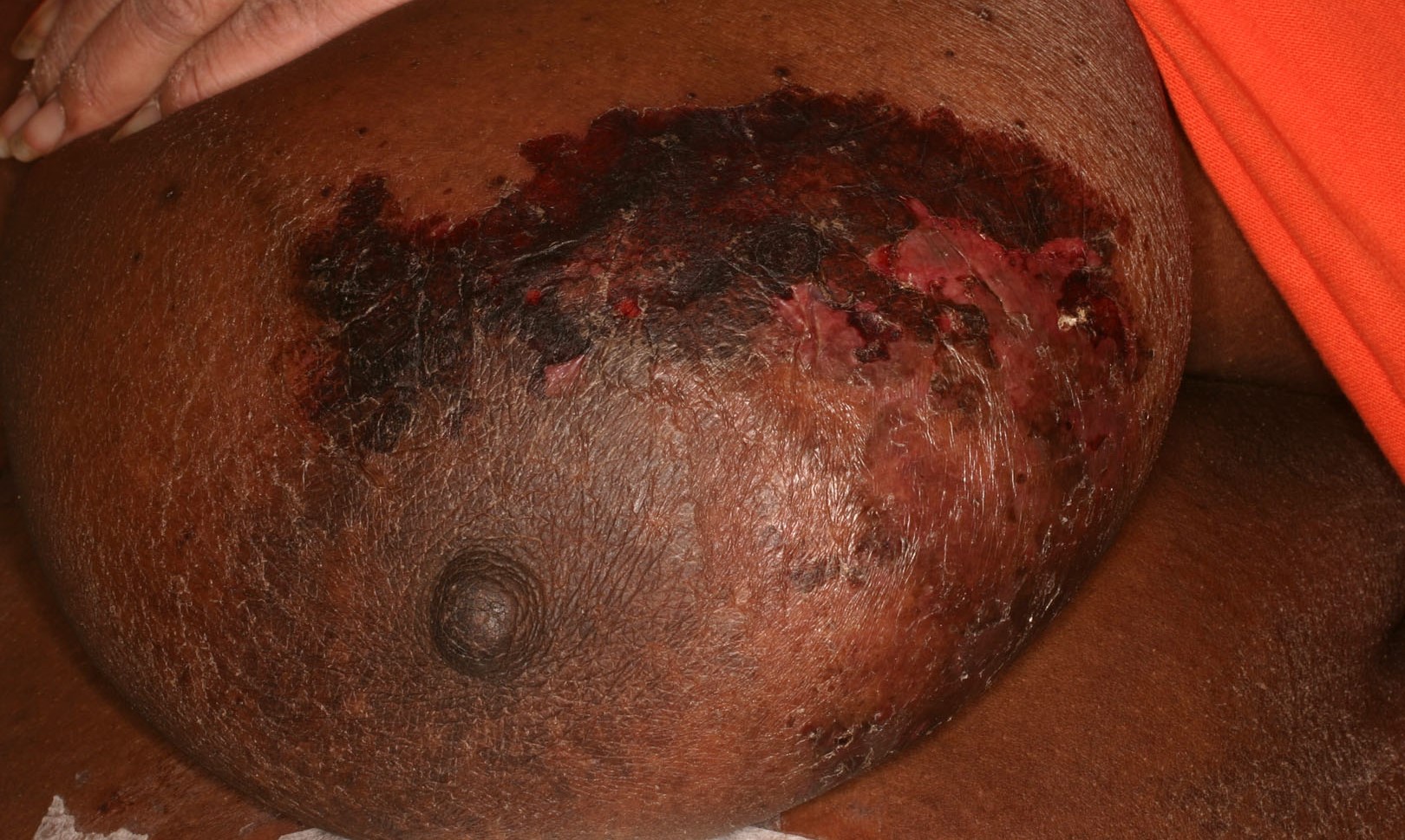 Calciphylaxis Type 6b