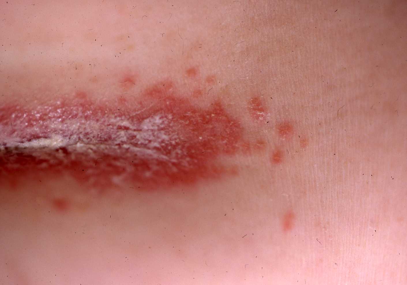 Candida Type 1a