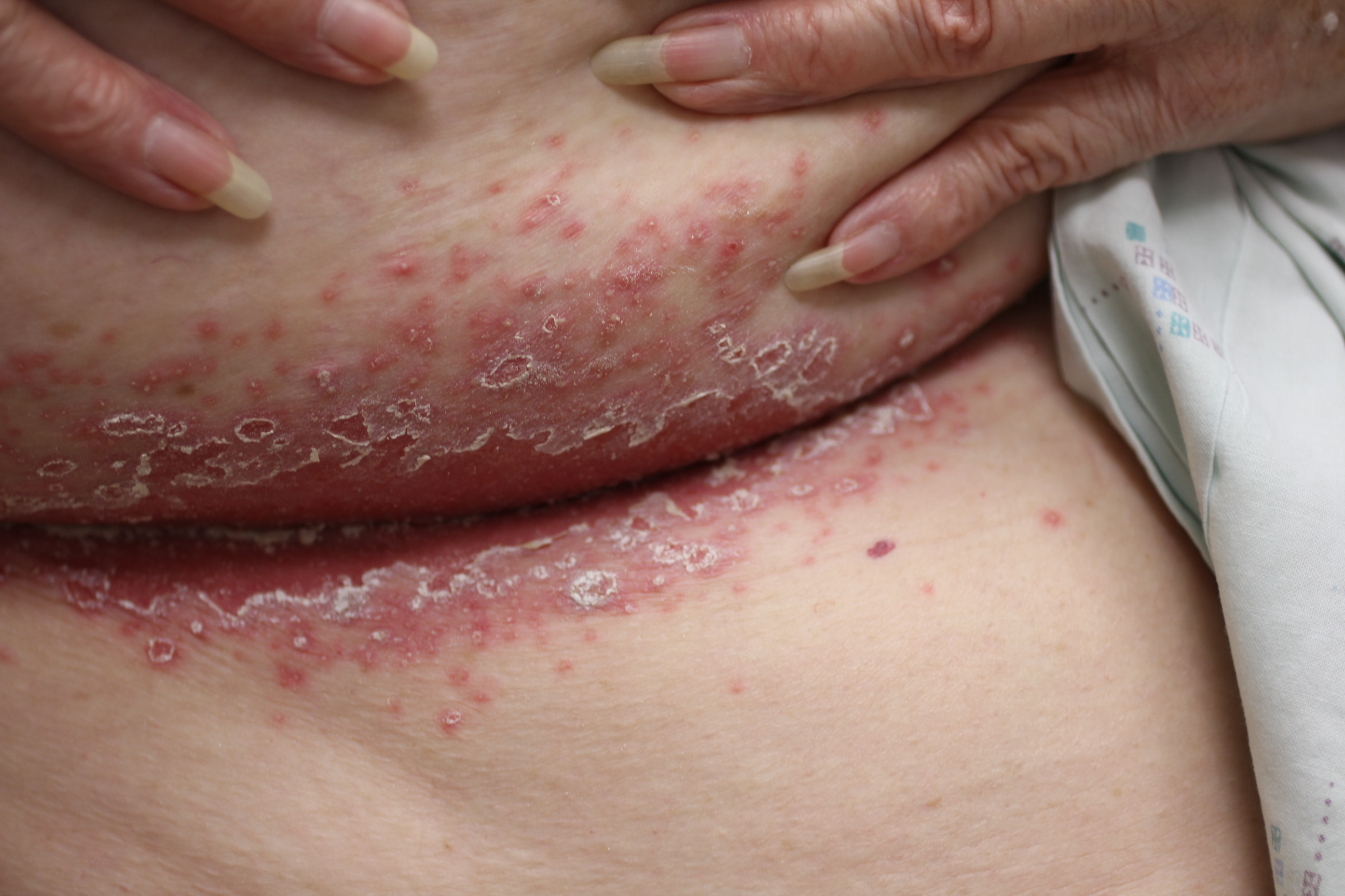 Candida Type 1b