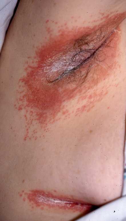 Candida Type 1c