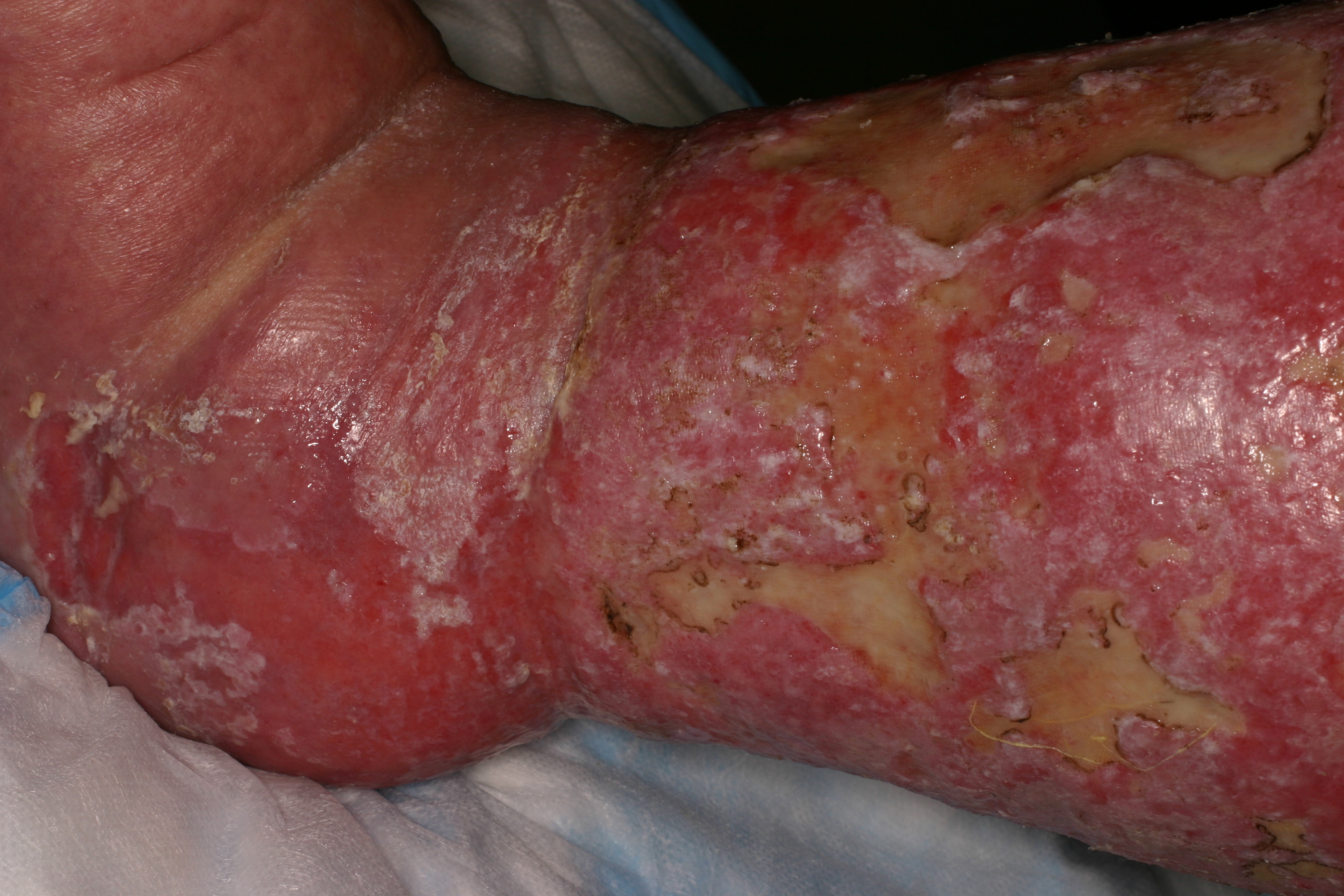 Candida