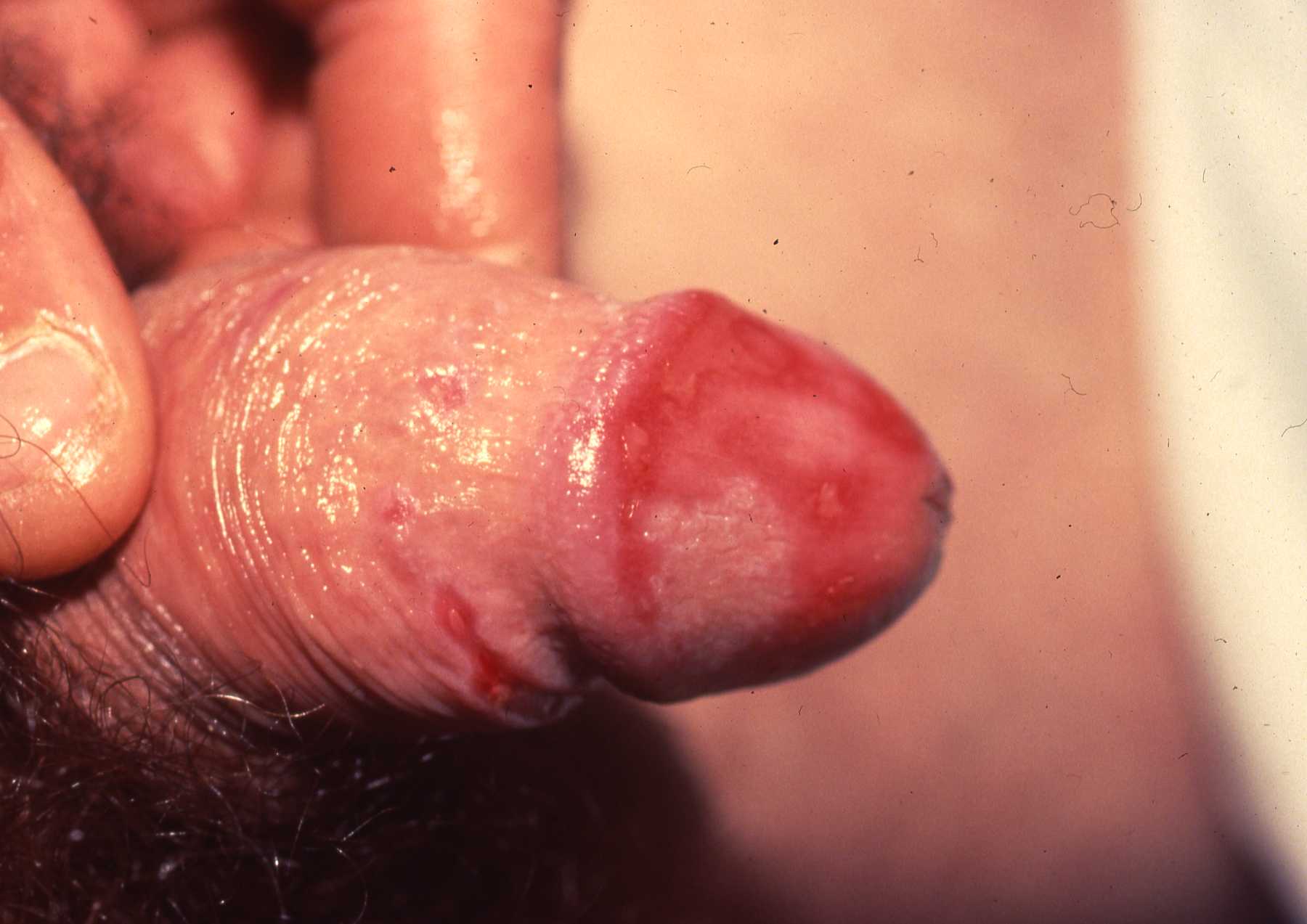Candida Type 2b
