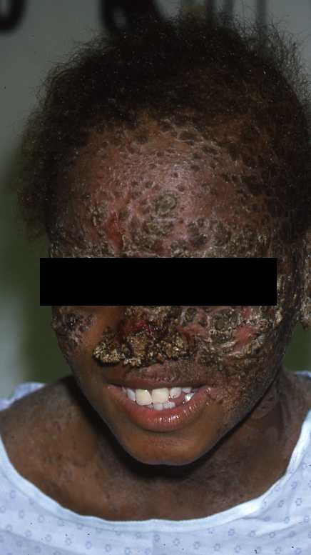 Candida Type 6a