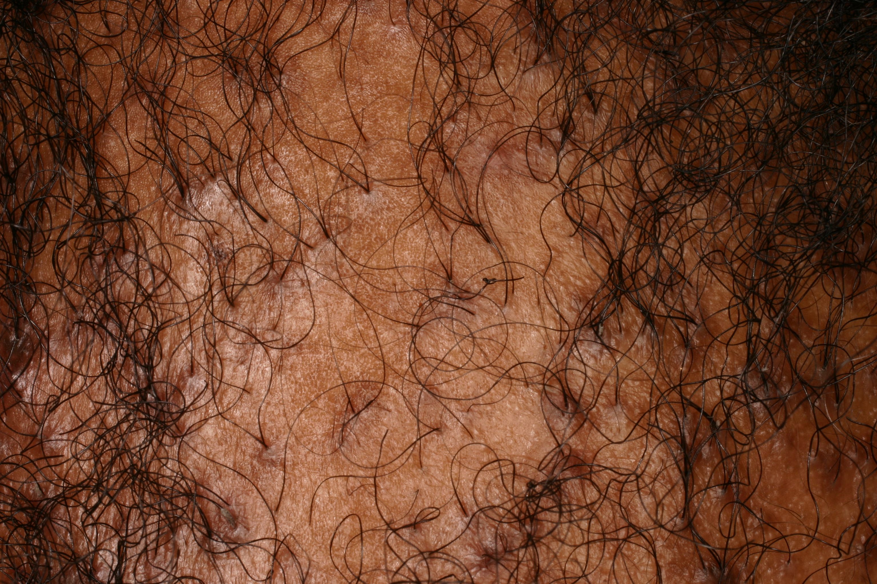 Central Centrifigul Alopecia (CCA) Type 6c