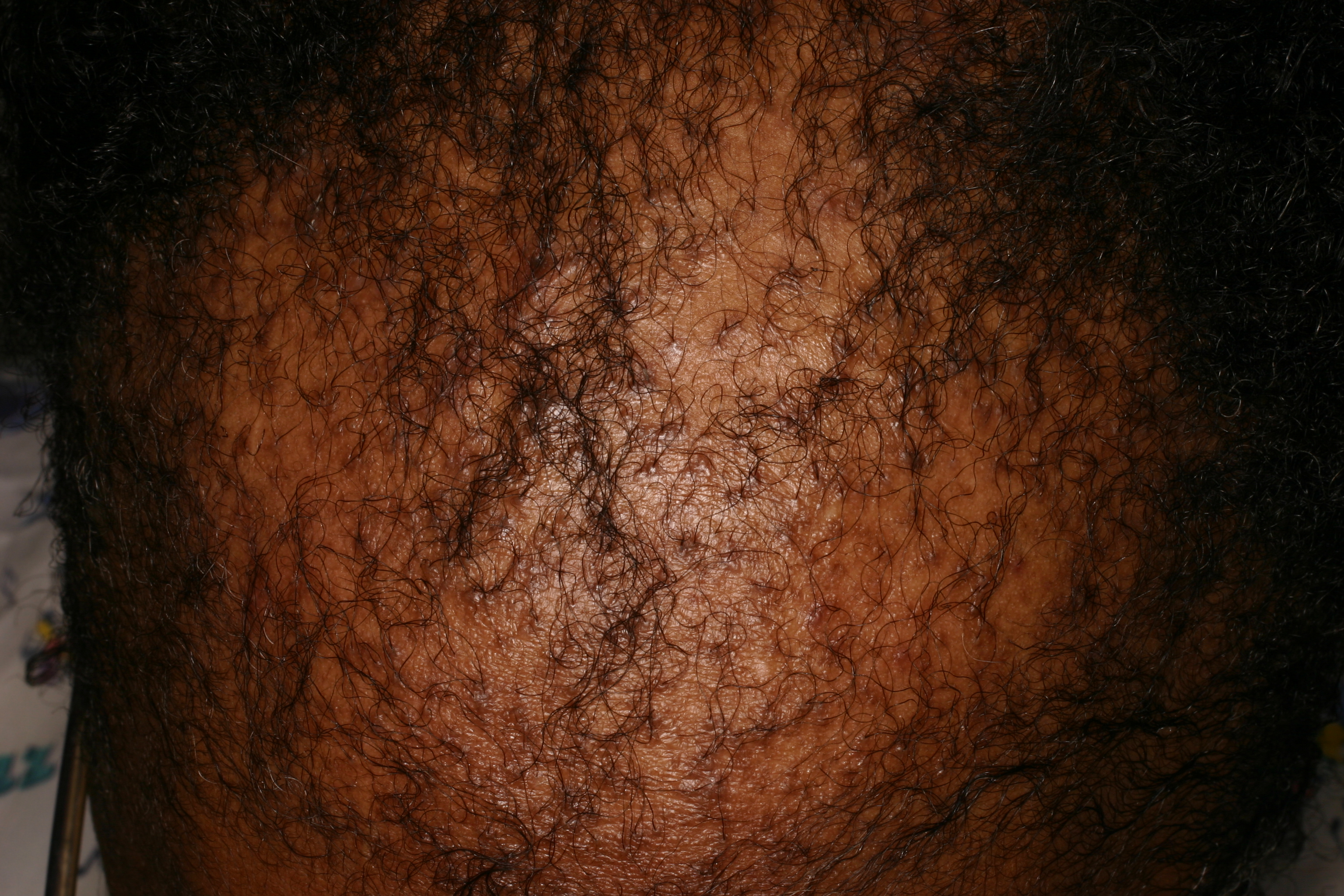 Central Centrifugal Alopecia (CCA) 