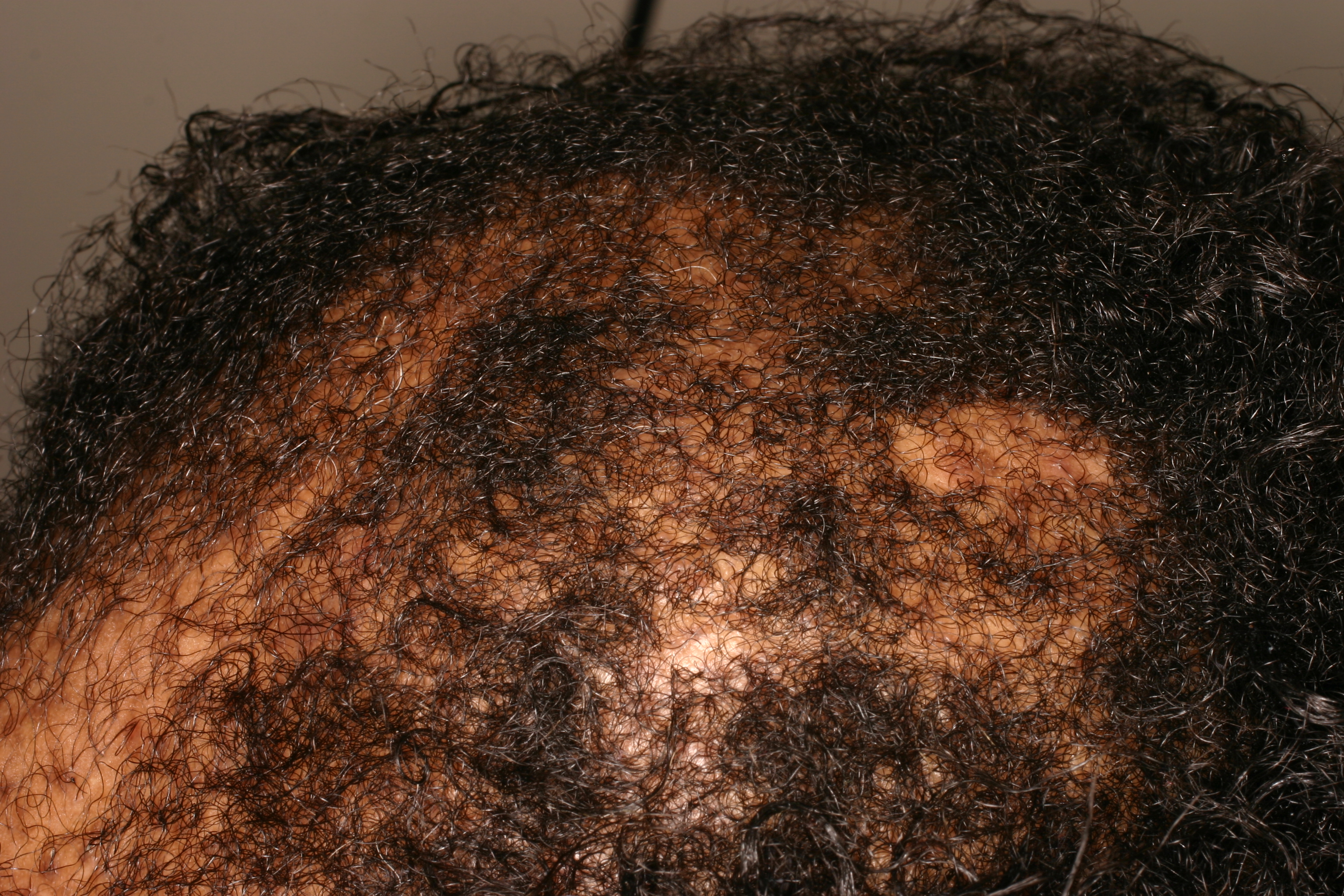 Central Centrifigul Alopecia (CCA) Type 6b