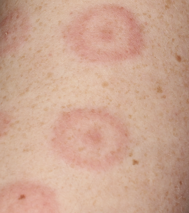 erythema annulare centrifugum 1a