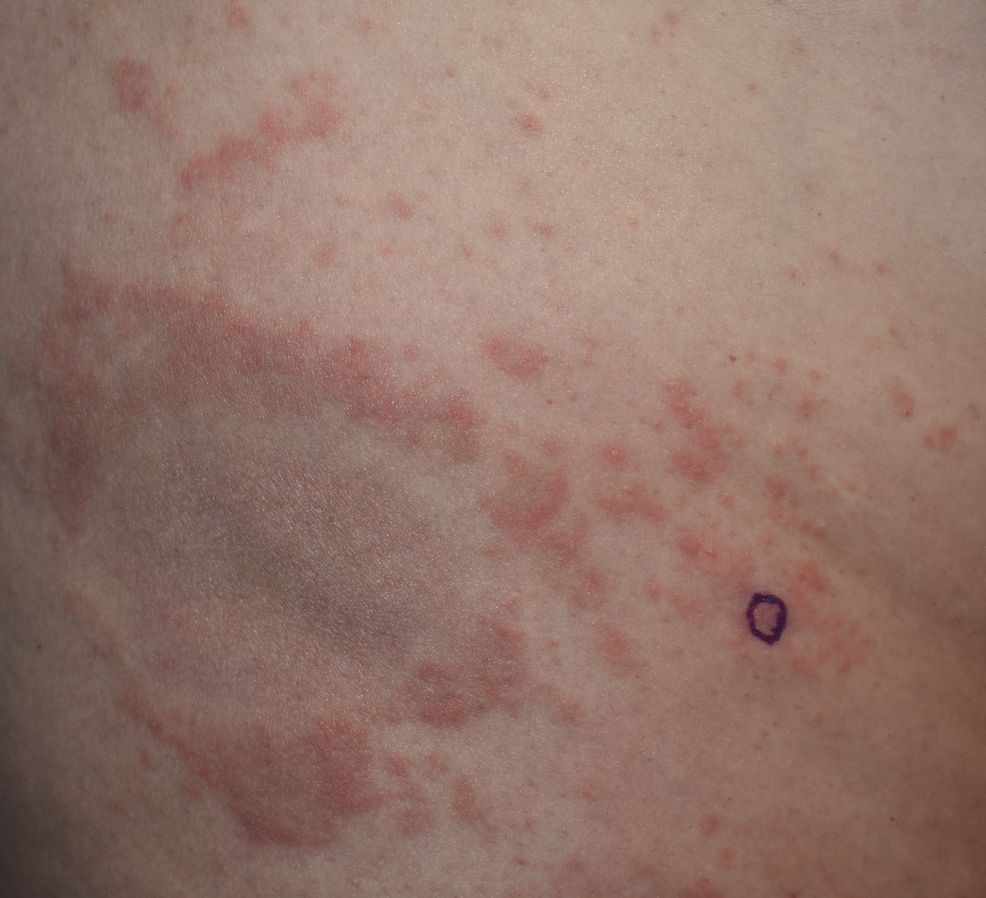 erythema annulare centrifugum 1b