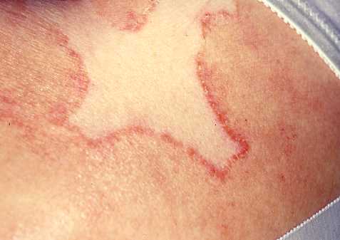 erythema annulare centrifugum 2a