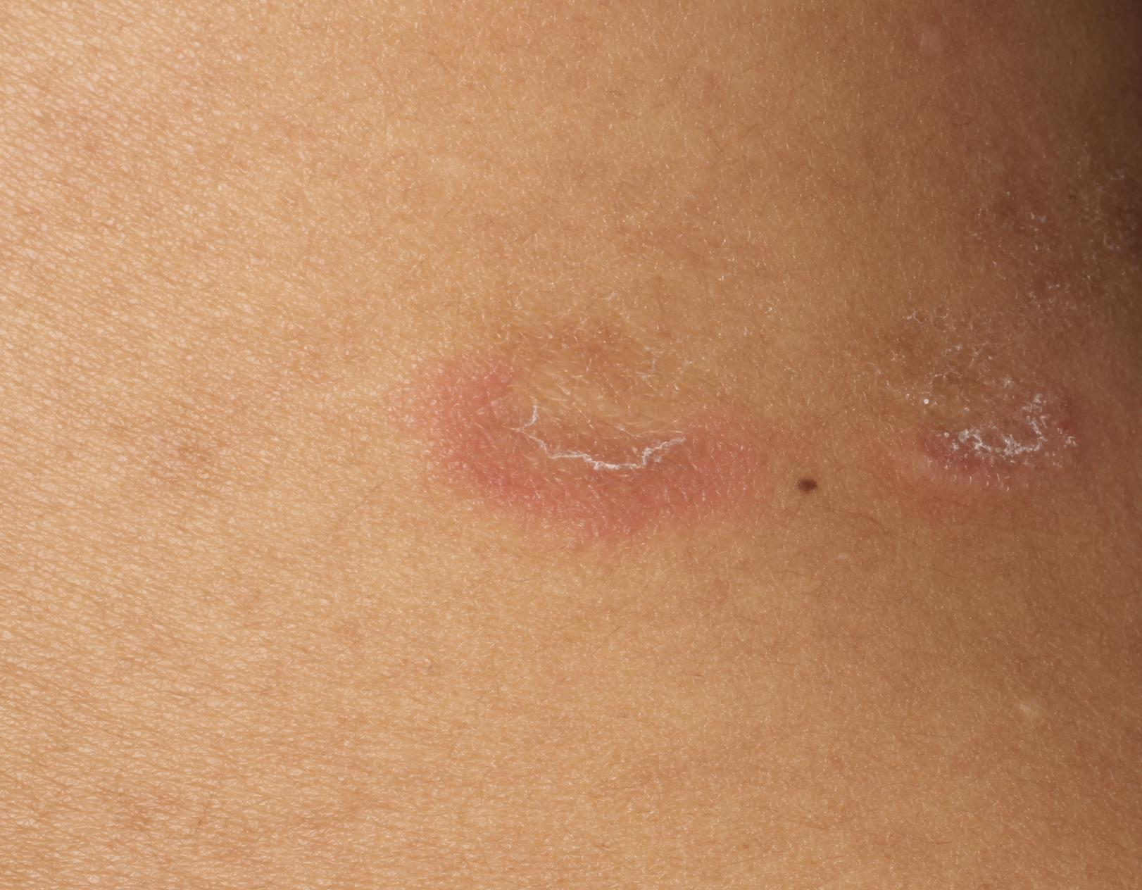 erythema annulare centrifugum 2b