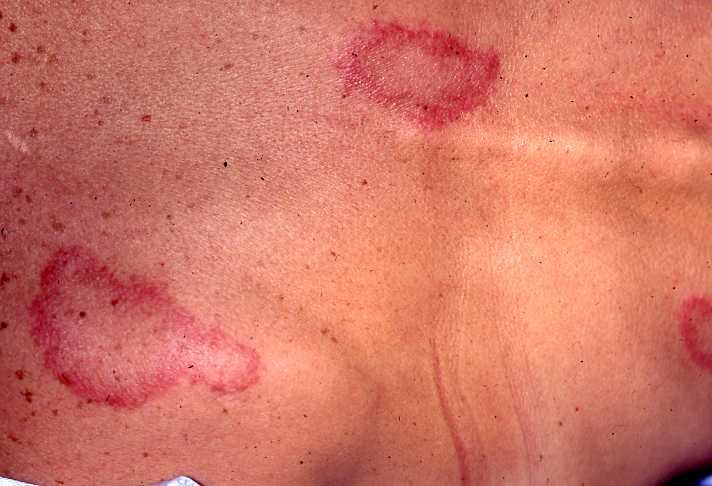 Erythema Annulare Centrifugum
