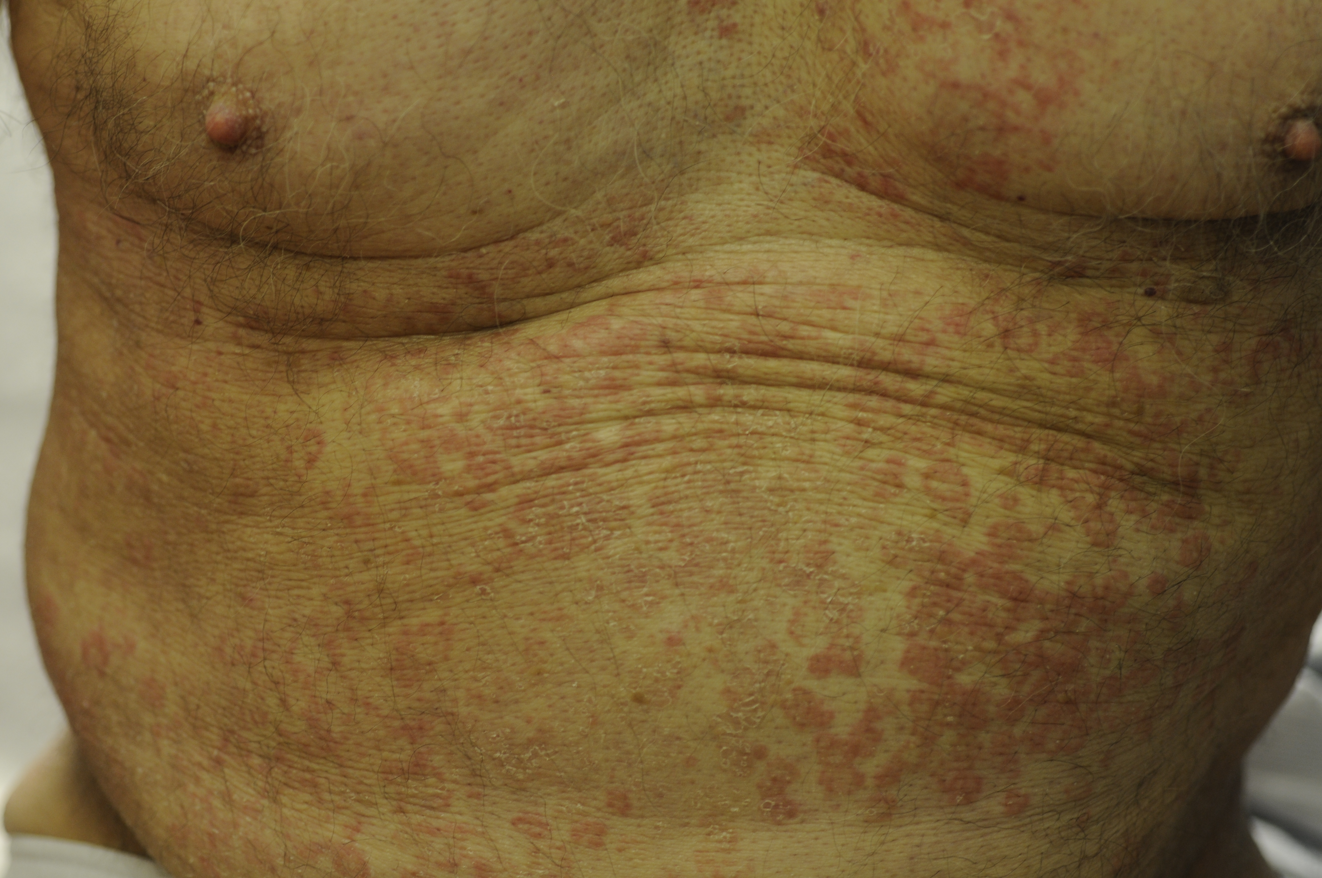 erythema annulare centrifugum 3b