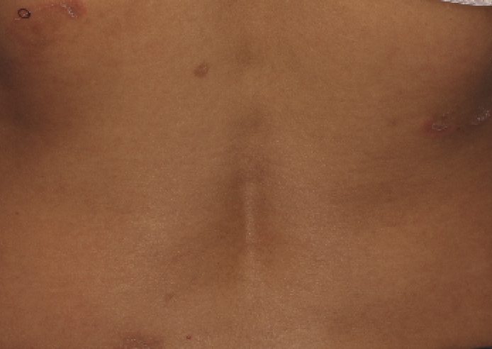 erythema annulare centrifugum 4a