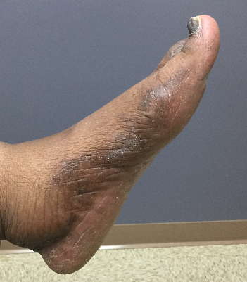 erythema annulare centrifugum 5a