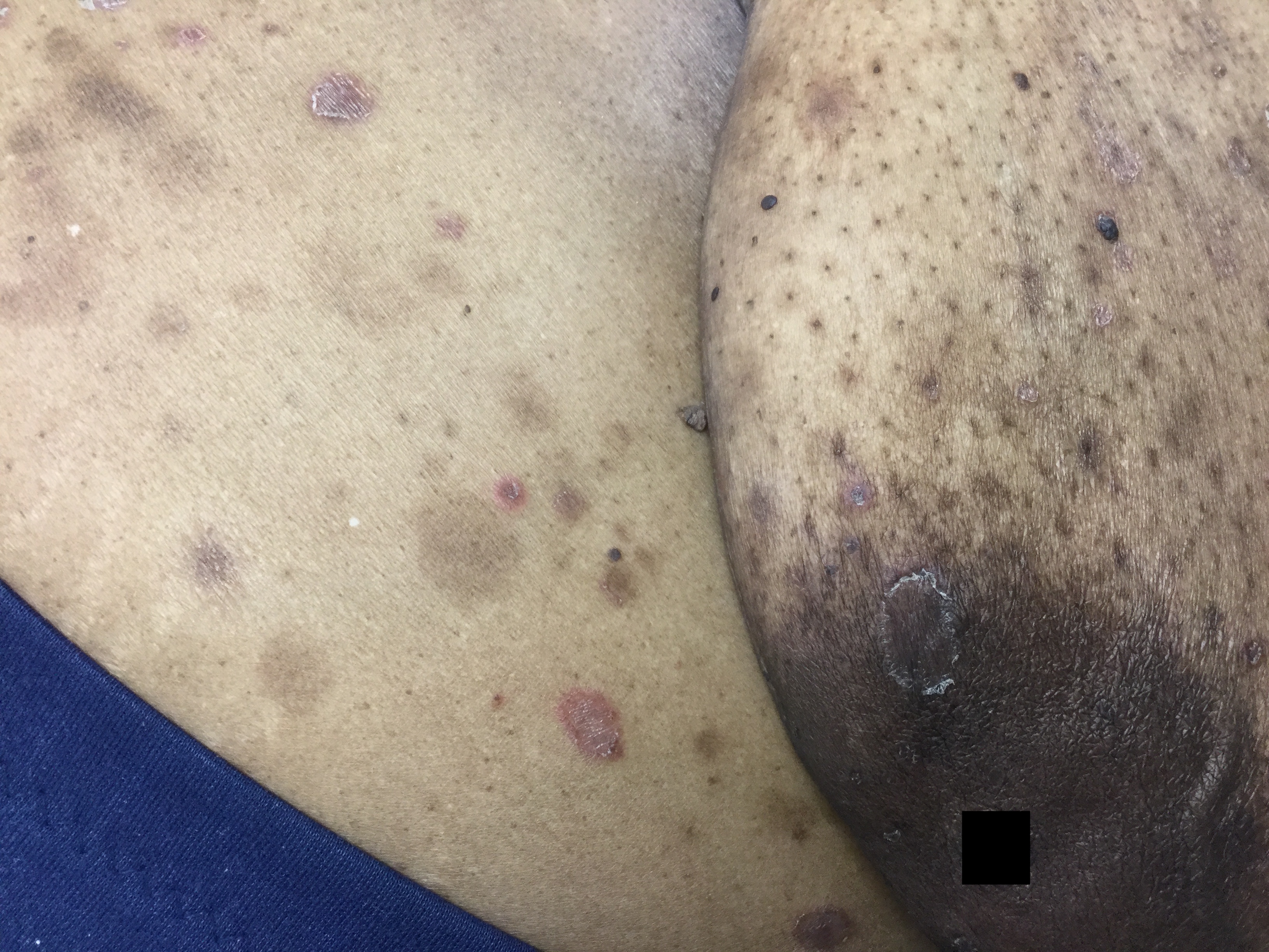 erythema annulare centrifugum 5b
