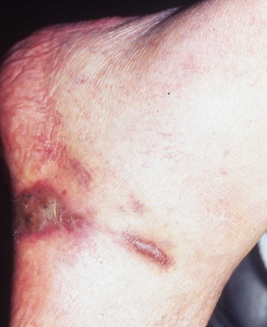 Kaposi Sarcoma Type 1a