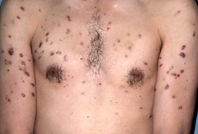 Kaposi Sarcoma Type 3a