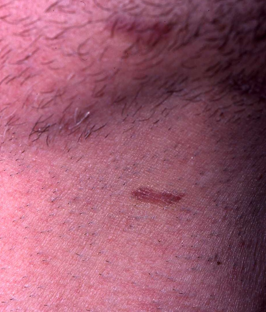 Kaposi Sarcoma Type 4a