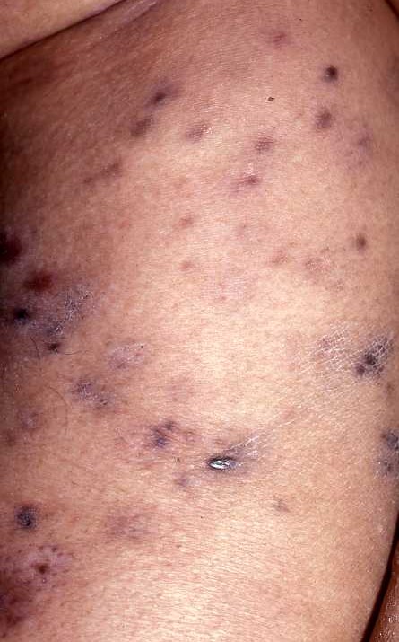 Kaposi Sarcoma Type 4b