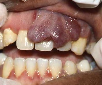 Kaposi Sarcoma Type 5a