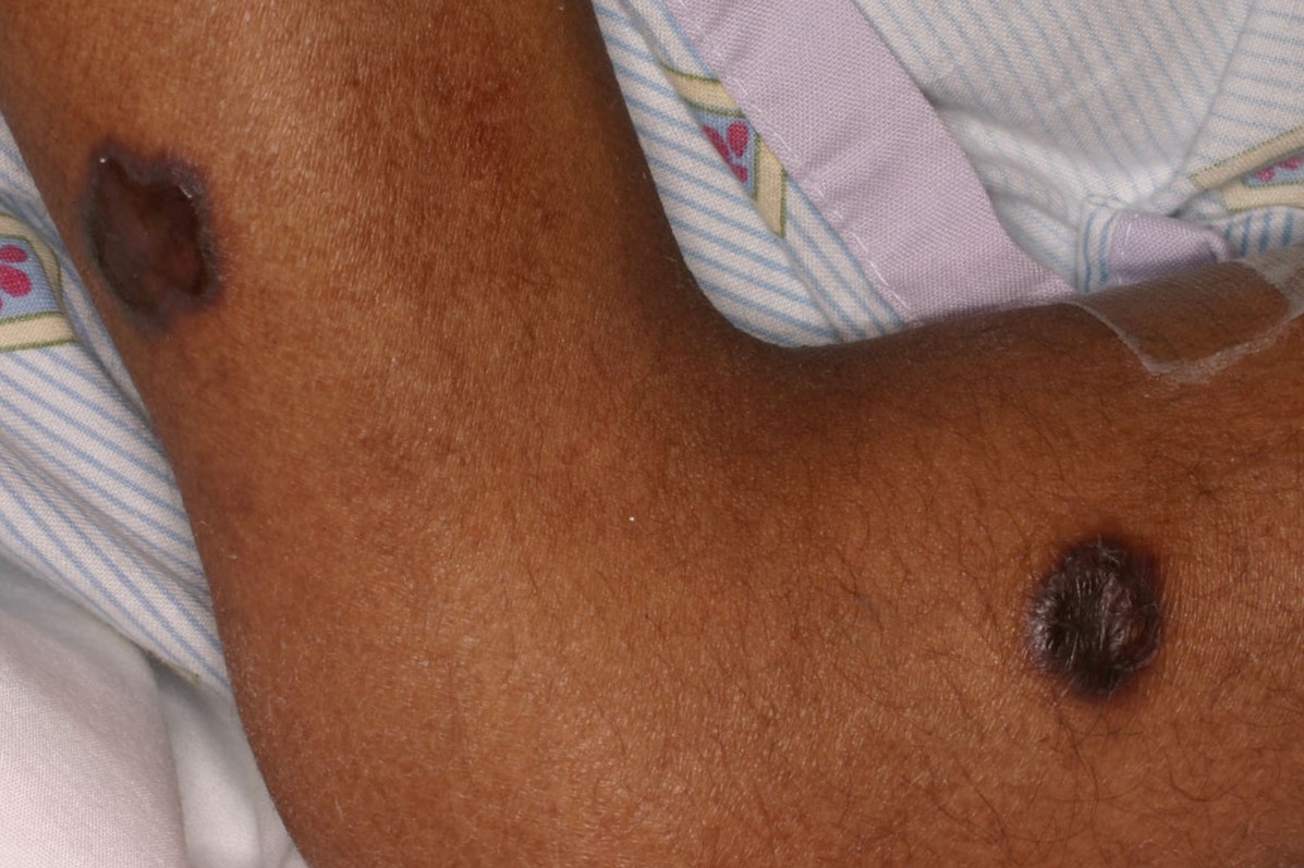 Kaposi Sarcoma Type 5b