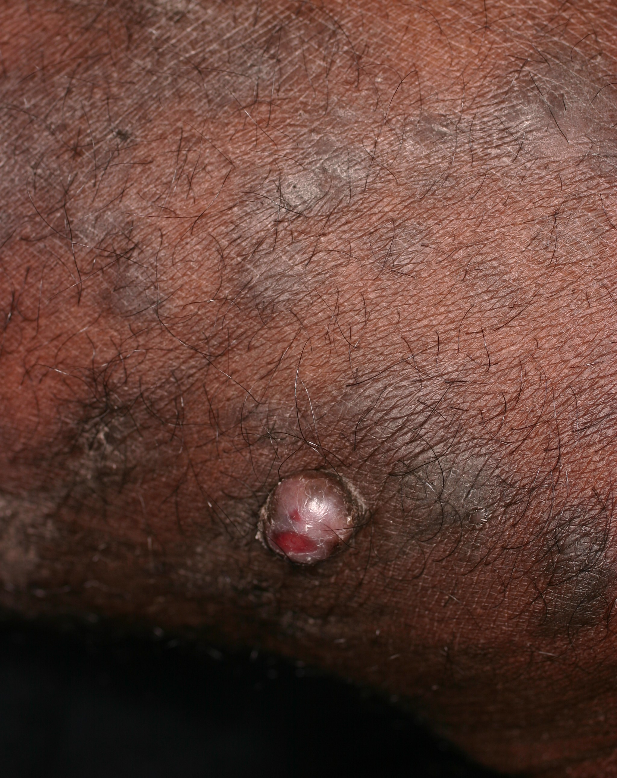 Kaposi Sarcoma Type 6a