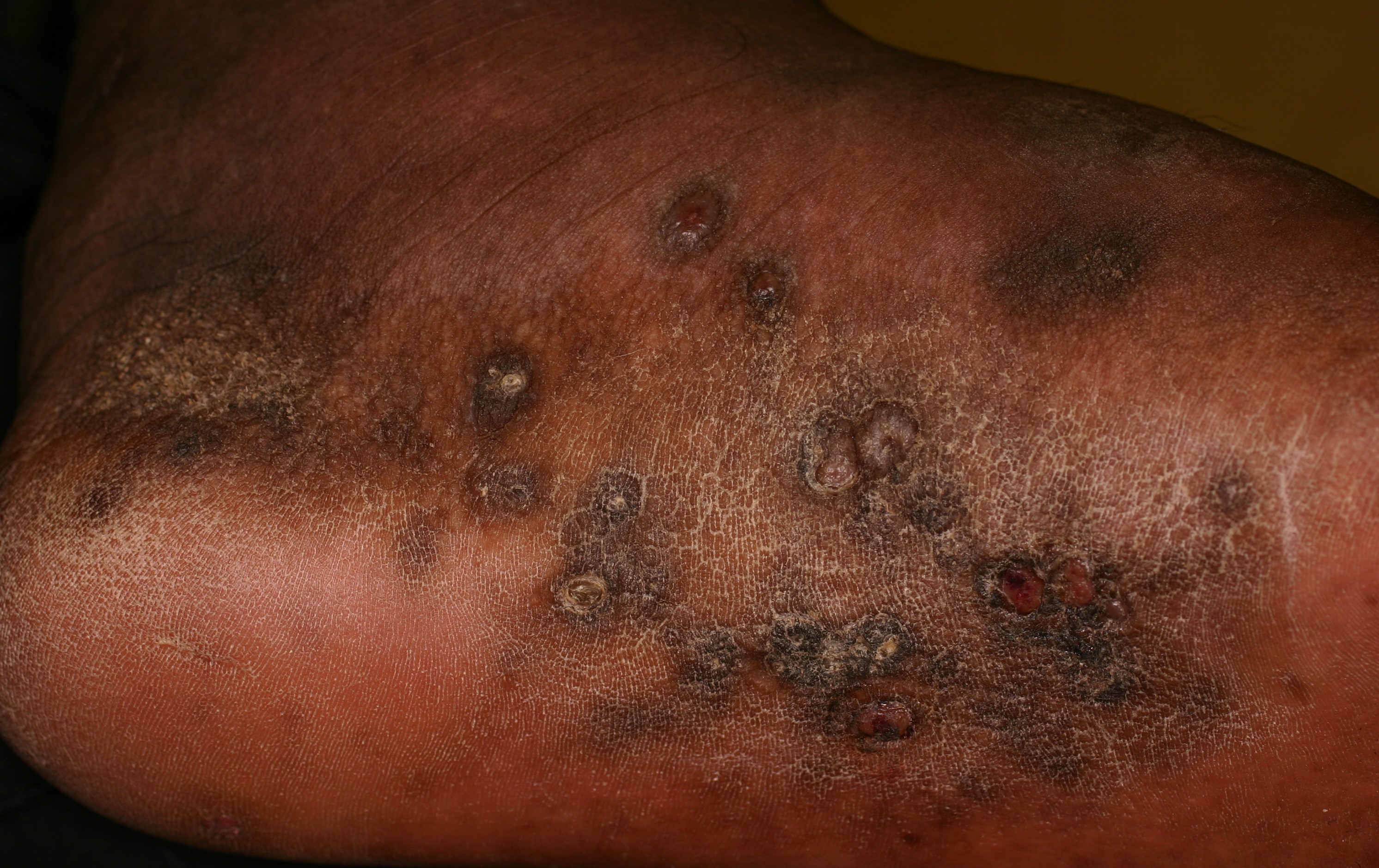 Kaposi Sarcoma