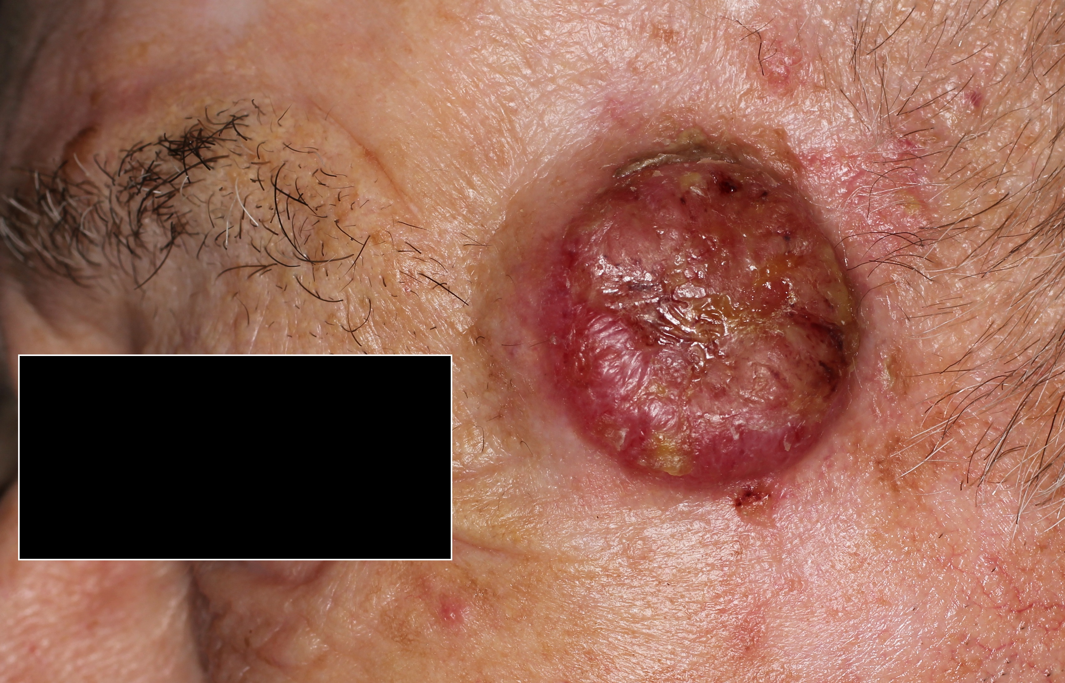 Merkel Cell Carcinoma