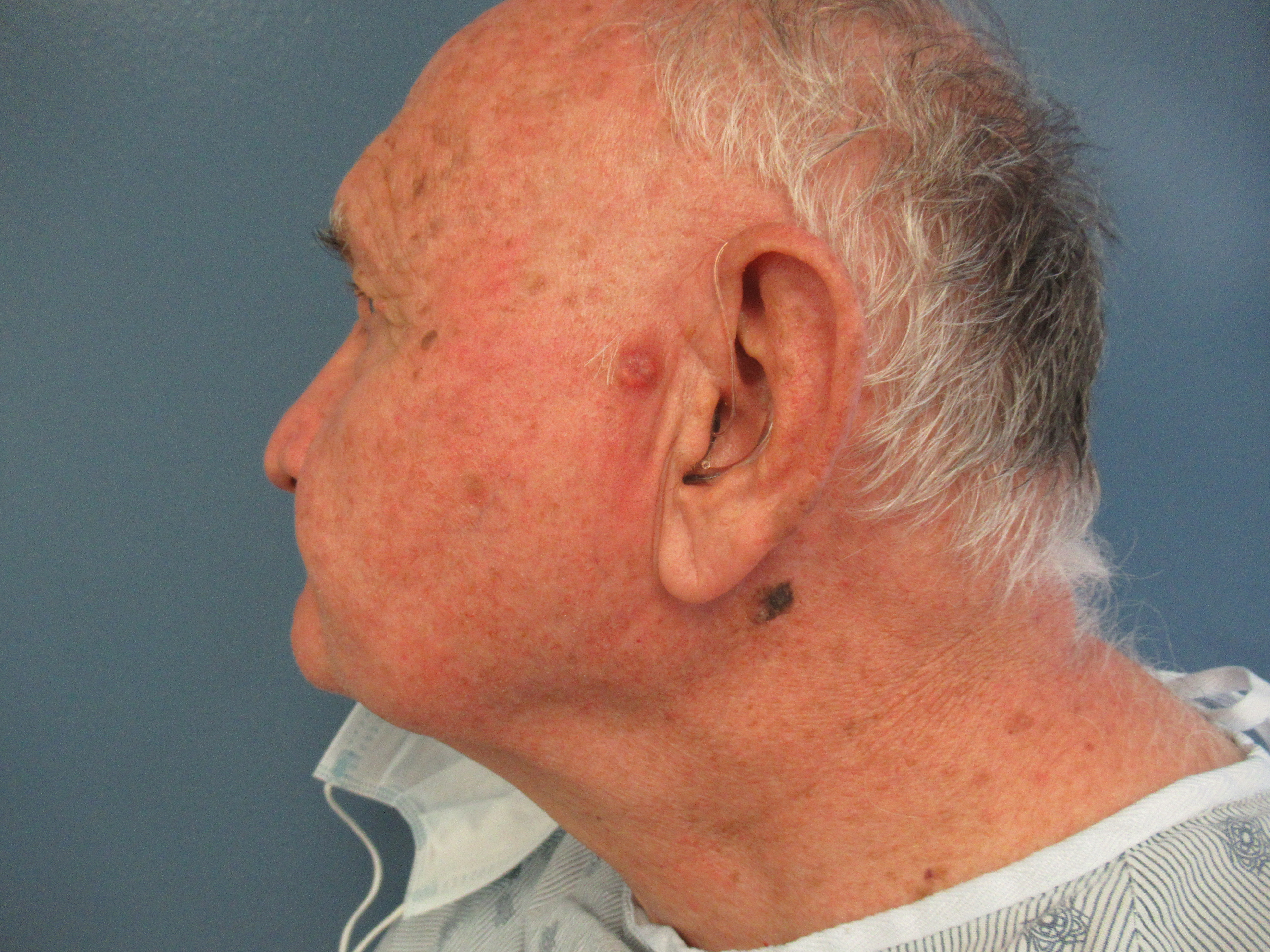 Merkel Cell Carcinoma 1b